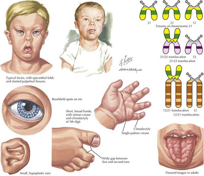 Down Syndrome Research